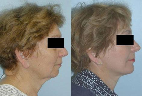 Facelift before and after photos in San Francisco, CA, Patient 14399