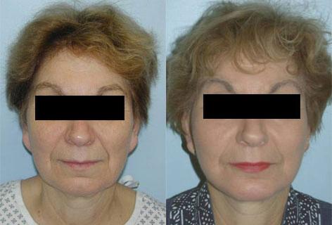 Facelift before and after photos in San Francisco, CA, Patient 14399