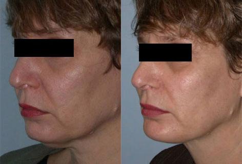 Facelift before and after photos in San Francisco, CA, Patient 14406