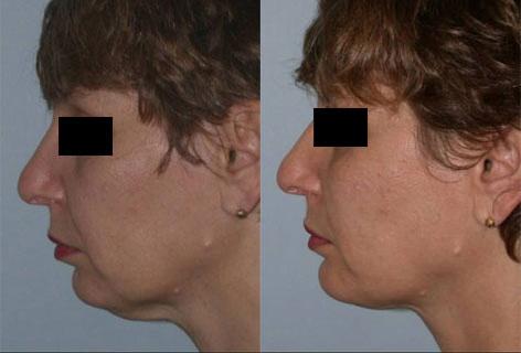 Facelift before and after photos in San Francisco, CA, Patient 14406