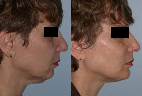 Facelift before and after photos in San Francisco, CA, Patient 14406