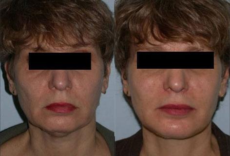 Facelift before and after photos in San Francisco, CA, Patient 14406