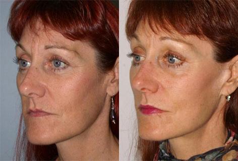 Facelift before and after photos in San Francisco, CA, Patient 14415