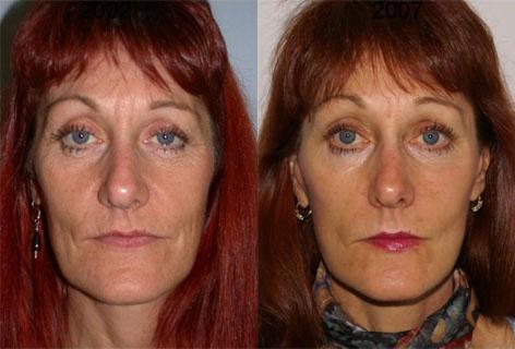 Facelift before and after photos in San Francisco, CA, Patient 14415