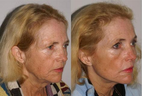 Facelift before and after photos in San Francisco, CA, Patient 14427