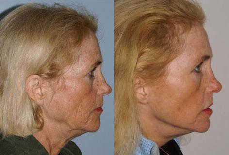 Facelift before and after photos in San Francisco, CA, Patient 14427