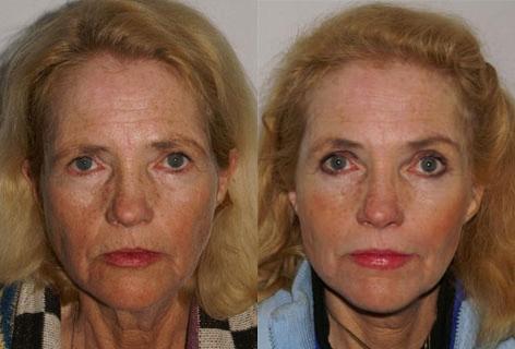 Facelift before and after photos in San Francisco, CA, Patient 14427