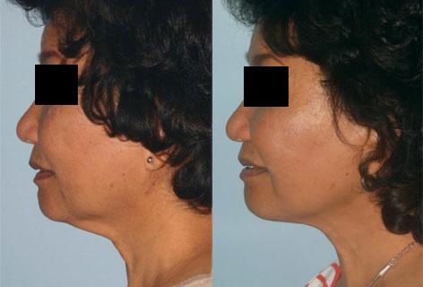 Facelift before and after photos in San Francisco, CA, Patient 14434