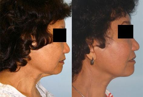 Patient 14434, Facelift before and after photos Facelift before and after photos in San Francisco, CA, Patient 14434