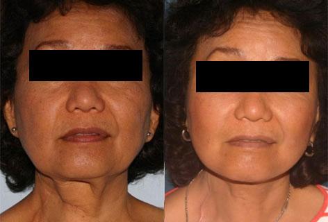 Facelift before and after photos in San Francisco, CA, Patient 14434