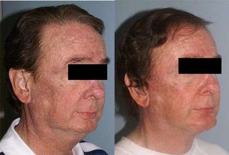 Facelift before and after photos in San Francisco, CA, Patient 14441