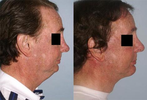 Facelift before and after photos in San Francisco, CA, Patient 14441