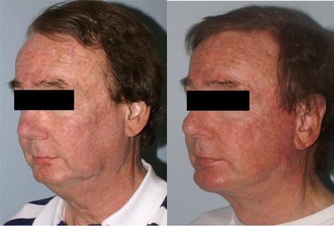 Facelift before and after photos in San Francisco, CA, Patient 14441