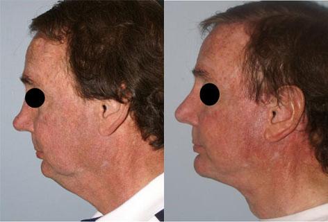 Facelift before and after photos in San Francisco, CA, Patient 14441