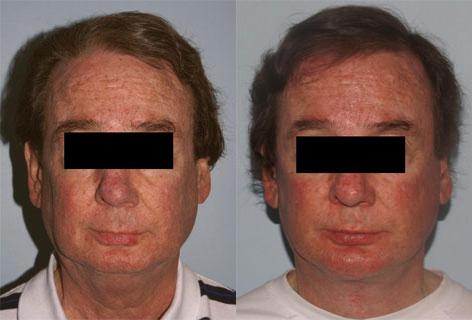 Facelift before and after photos in San Francisco, CA, Patient 14441