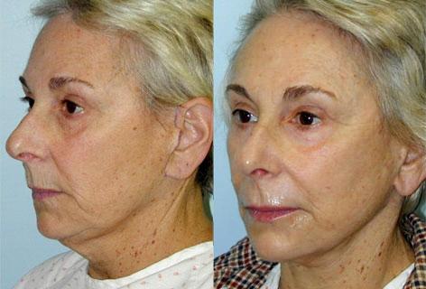 Facelift before and after photos in San Francisco, CA, Patient 14452