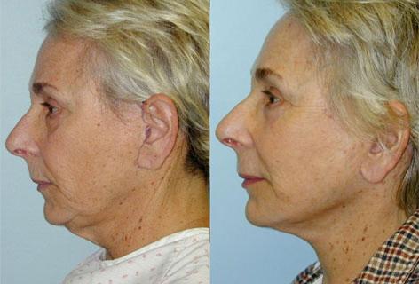 Facelift before and after photos in San Francisco, CA, Patient 14452