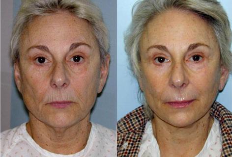 Facelift before and after photos in San Francisco, CA, Patient 14452