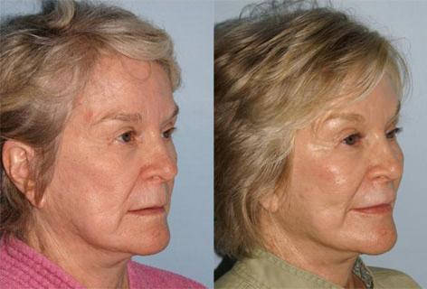 Facelift before and after photos in San Francisco, CA, Patient 14459