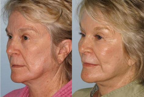 Facelift before and after photos in San Francisco, CA, Patient 14459