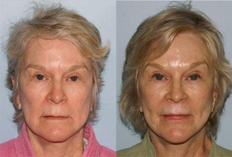 Facelift before and after photos in San Francisco, CA, Patient 14459