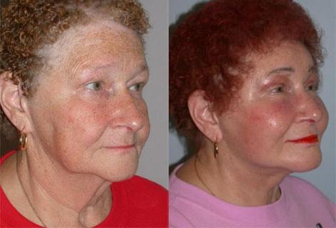 Facelift before and after photos in San Francisco, CA, Patient 14466