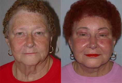 Facelift before and after photos in San Francisco, CA, Patient 14466