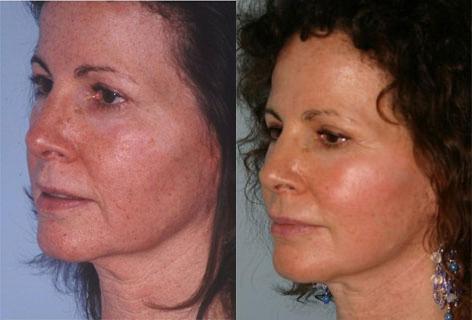 Facelift before and after photos in San Francisco, CA, Patient 14471