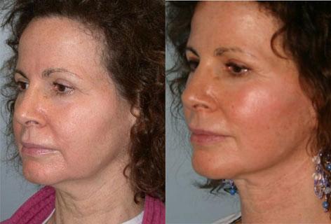 Facelift before and after photos in San Francisco, CA, Patient 14471