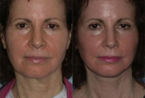 Facelift before and after photos in San Francisco, CA, Patient 14471