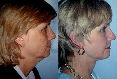 Facelift before and after photos in San Francisco, CA, Patient 14478