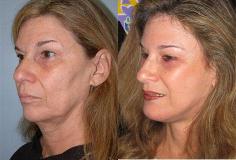 Facelift before and after photos in San Francisco, CA, Patient 14483