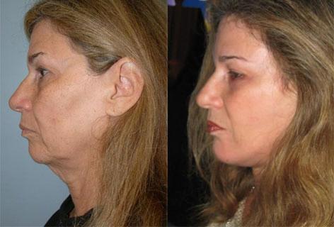 Facelift before and after photos in San Francisco, CA, Patient 14483