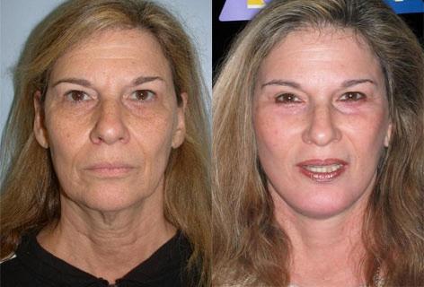 Facelift before and after photos in San Francisco, CA, Patient 14483