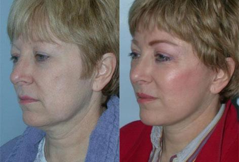 Facelift before and after photos in San Francisco, CA, Patient 14490