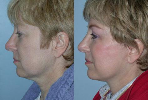 Facelift before and after photos in San Francisco, CA, Patient 14490