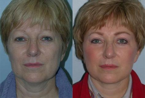 Facelift before and after photos in San Francisco, CA, Patient 14490