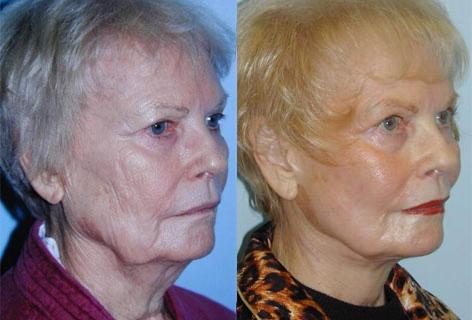 Facelift before and after photos in San Francisco, CA, Patient 14497