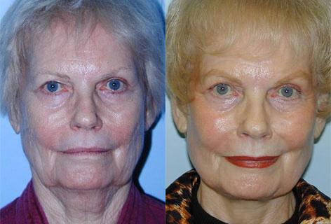 Facelift before and after photos in San Francisco, CA, Patient 14497