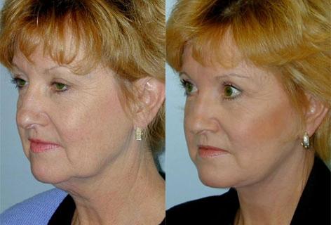 Facelift before and after photos in San Francisco, CA, Patient 14502