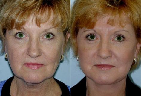 Facelift before and after photos in San Francisco, CA, Patient 14502