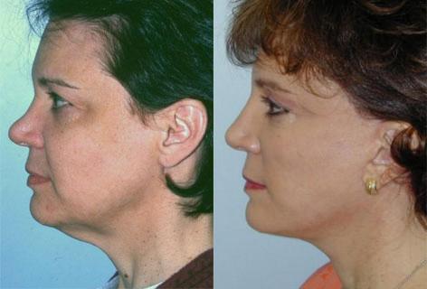 Facelift before and after photos in San Francisco, CA, Patient 14507