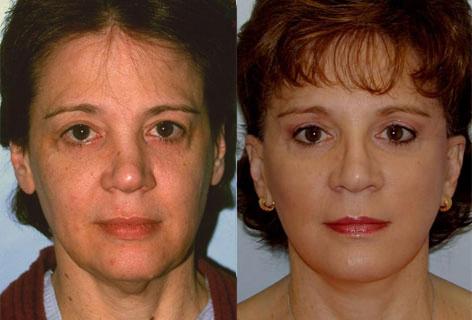 Facelift before and after photos in San Francisco, CA, Patient 14507