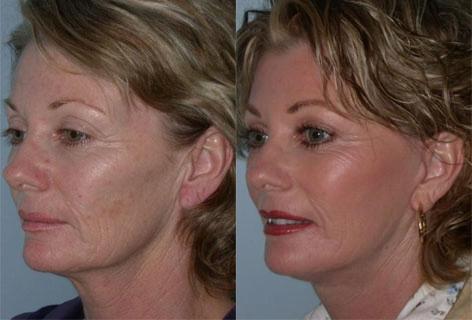 Facelift before and after photos in San Francisco, CA, Patient 14512