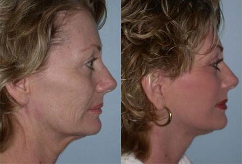 Facelift before and after photos in San Francisco, CA, Patient 14512