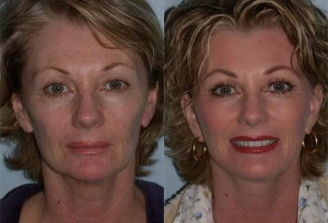 Facelift before and after photos in San Francisco, CA, Patient 14512