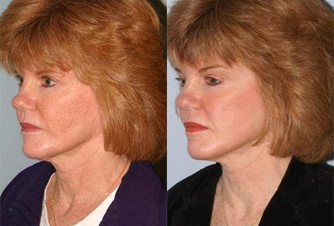 Facelift before and after photos in San Francisco, CA, Patient 14519