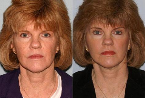 Facelift before and after photos in San Francisco, CA, Patient 14519