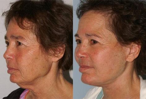 Facelift before and after photos in San Francisco, CA, Patient 14524