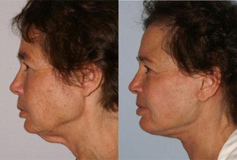 Facelift before and after photos in San Francisco, CA, Patient 14524